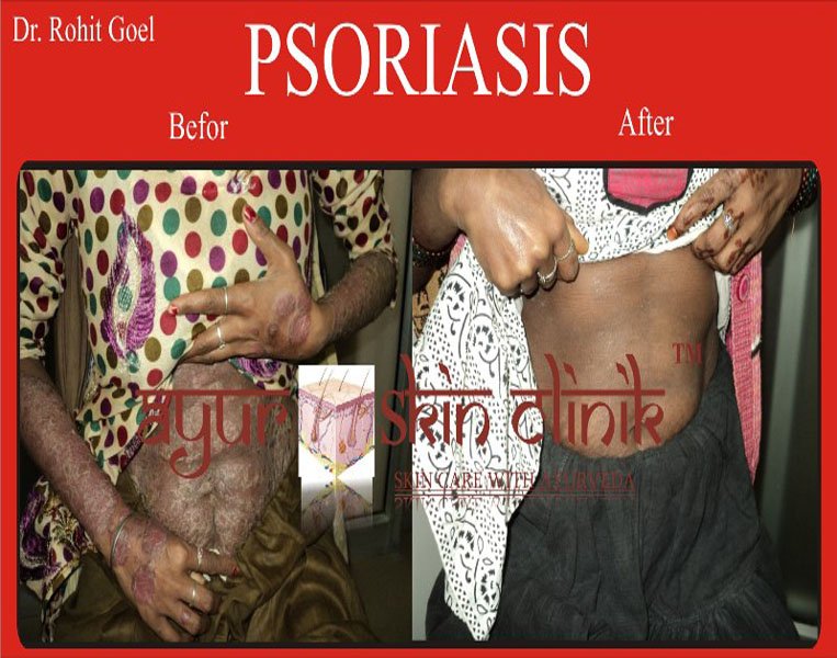 Before and after laser treatment result